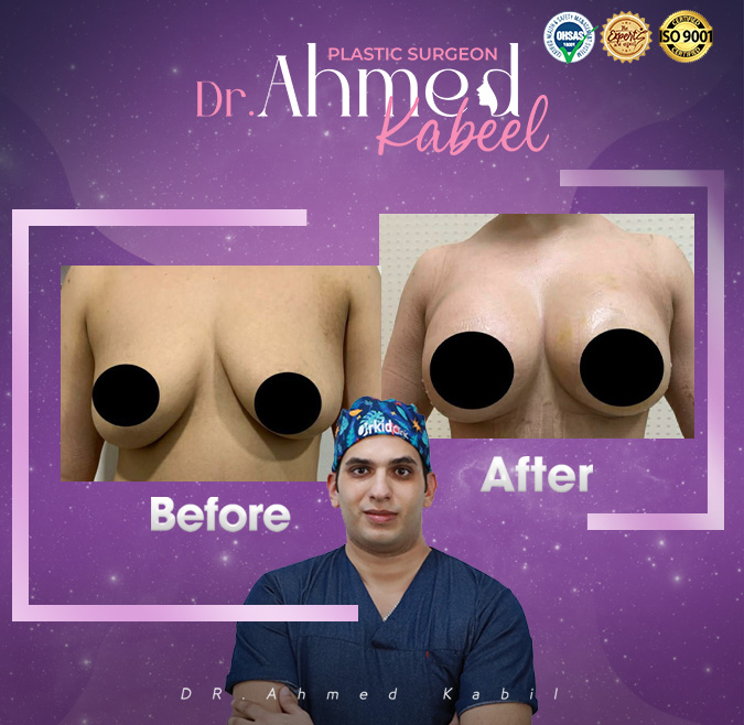 نجاح-عملية-تكبير-ورفع-الثدي